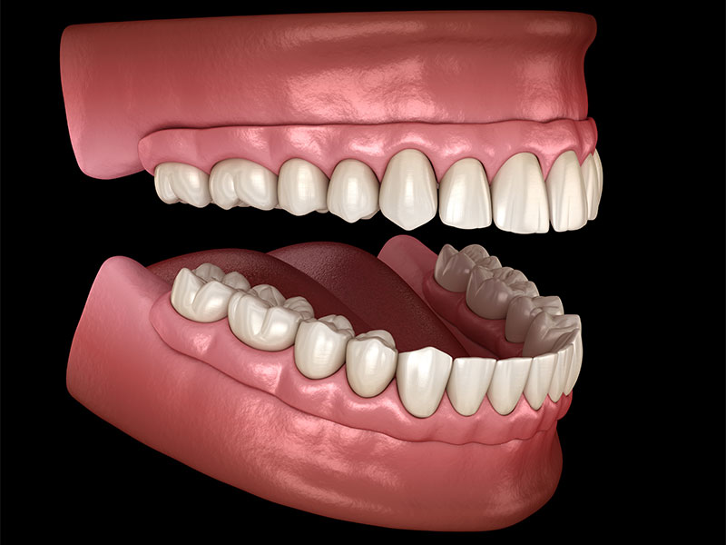Dentiere